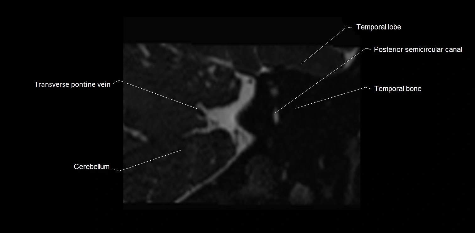 MRI Internal auditory meatus (IAM) coronal cross sectional labelled anatomy image 34.webp